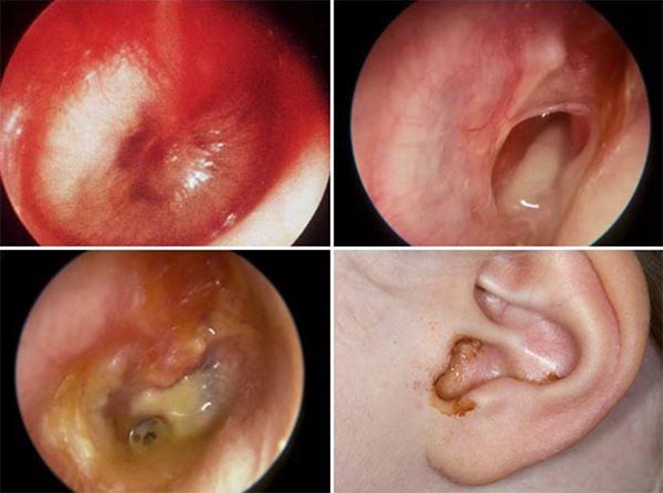 Viêm tai giữa ở trẻ và nguyên nhân gây bệnh