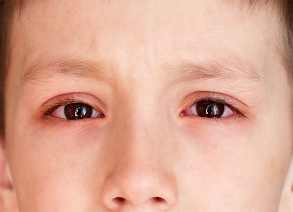 Đau mắt đỏ có thể gây nhiều biến chứng khác nhau cho trẻ
