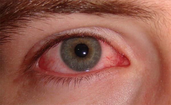 Người bị đau mắt đỏ cần chú ý chăm sóc như nào?