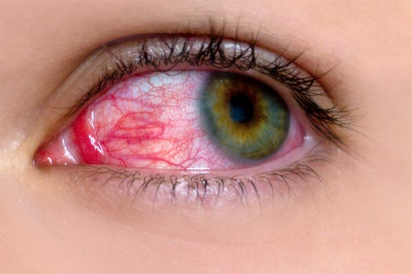 Bệnh đau mắt đỏ là gì?